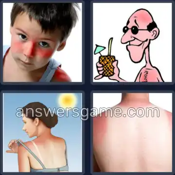 4 Pics 1 Word 7 Letters SUNBURN